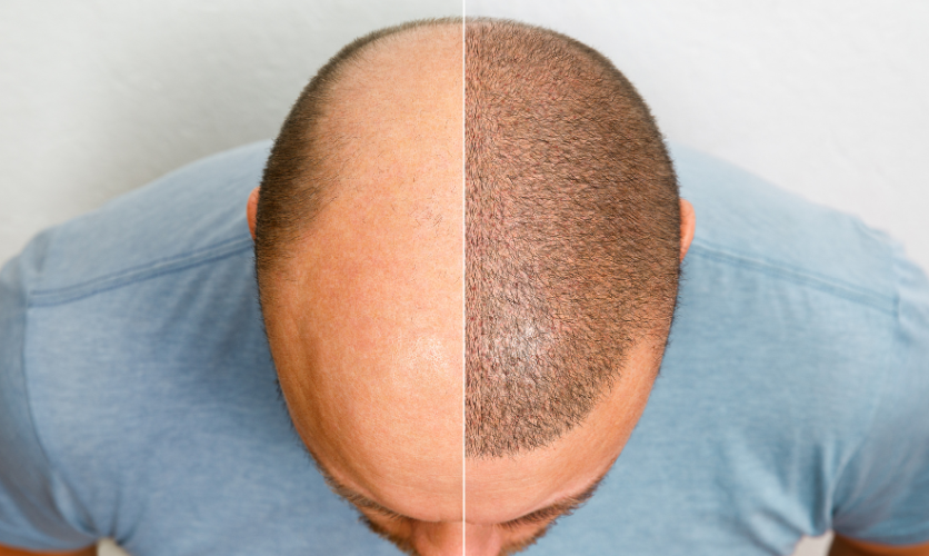 Hair Transplant in Coimbatore