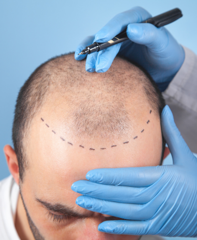 Hair Transplant in Coimbatore